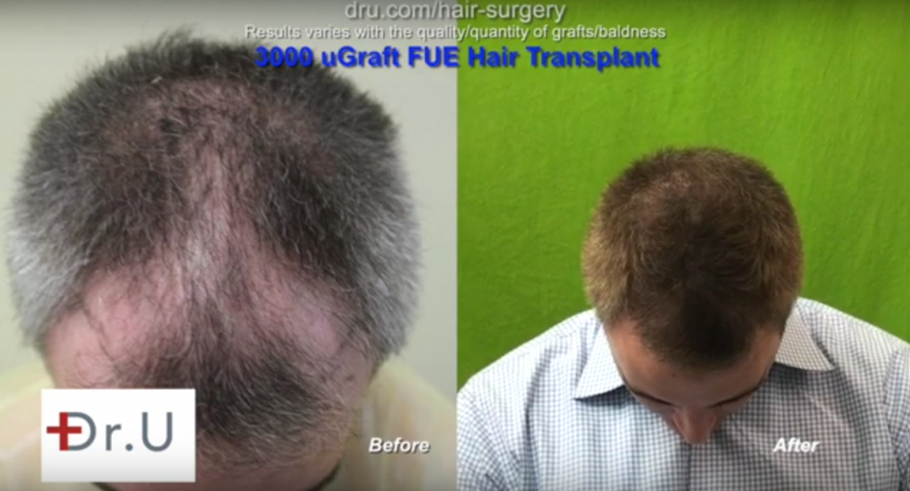 UGraft using 3000 head hair donor grafts only - Top view before and after