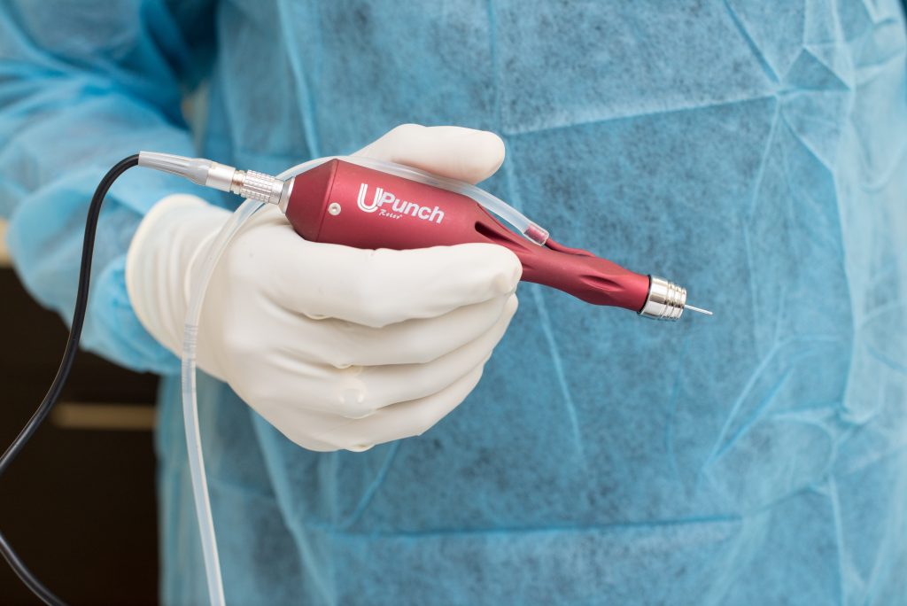 Dr U displacing the UGraft hand piece called UPunch Rotor which he uses to perform UGraft FUE hair transplant Dr U displacing the UGraft hand piece called UPunch Rotor which he uses to perform UGraft FUE hair transplant