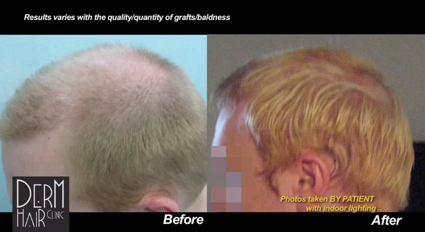 Side view of FUE Transplant With Body Hair Side view of FUE Transplant With Body Hair
