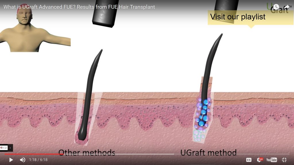 UGraft drops protective fluid shield around the follicle during FUE