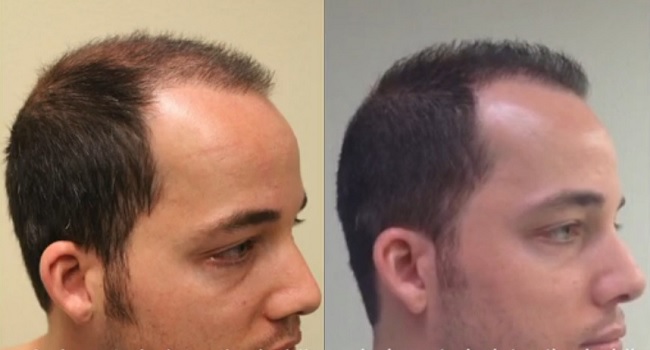 before-after-temples-FUE-right.jpg