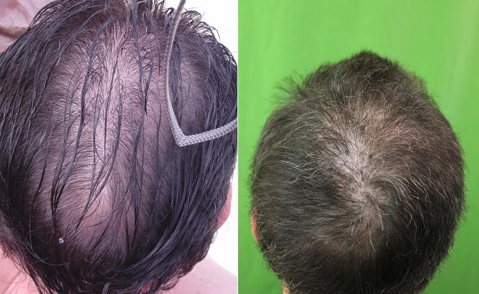 crown-before-after1.jpg