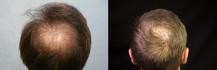 http://www.dermhairclinic.com/wp-content/uploads/crown-before-after2.jpg