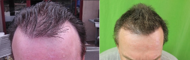 http://www.dermhairclinic.com/wp-content/uploads/front-before-after.jpg