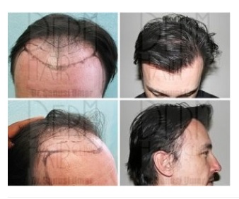 Hairline planning before and after Los Angeles UGraft FUE hair restoration