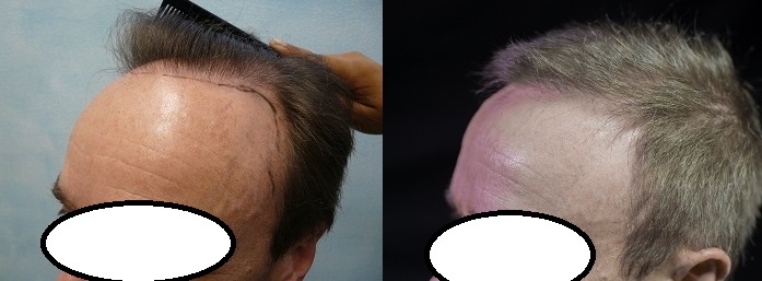 http://www.dermhairclinic.com/wp-content/uploads/left-temples-before-after.jpg