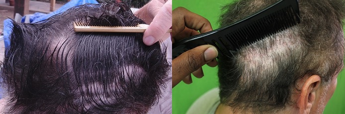 http://www.dermhairclinic.com/wp-content/uploads/right-rear-scarring-before-after.jpg