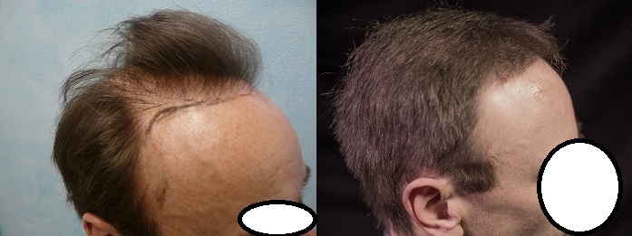 http://www.dermhairclinic.com/wp-content/uploads/right-temple-before-after.jpg