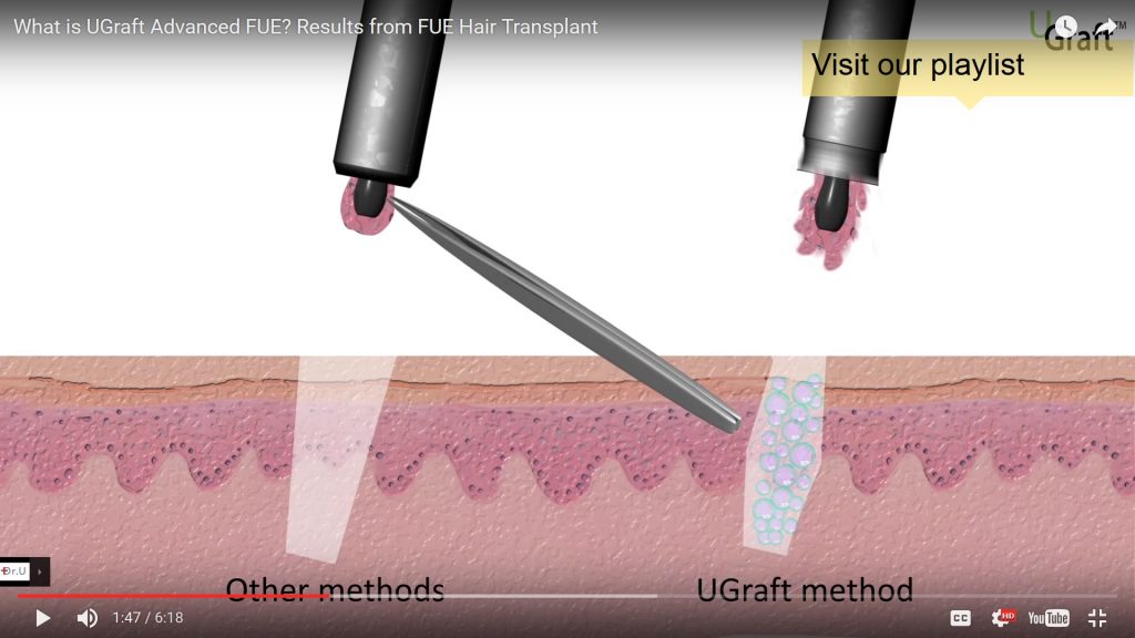 upunch flush vs ordinary FUE forcep manual removal of impacted grafts