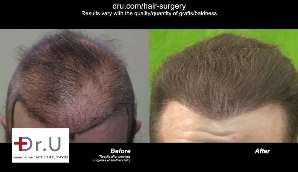 Bad FUE Hair Restoration Surgery In A Young Patient