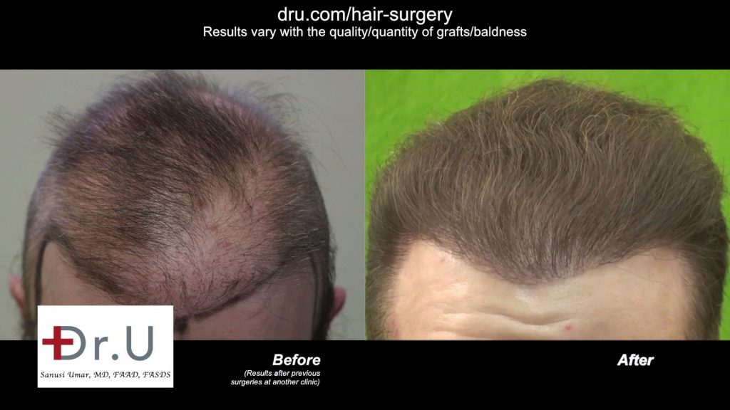 Bad FUE Hair Restoration Surgery In A Young Patient: Before and after BHT repair using DrUGraft Revolution advanced FUE with beard, nape and chest hair donors