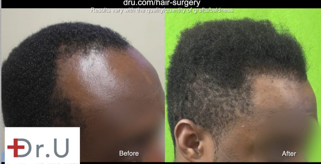 UGraft follicular Unit Extraction works for all curly hair including all of African Americans, patients due to a new patent pending new invention by Dr U