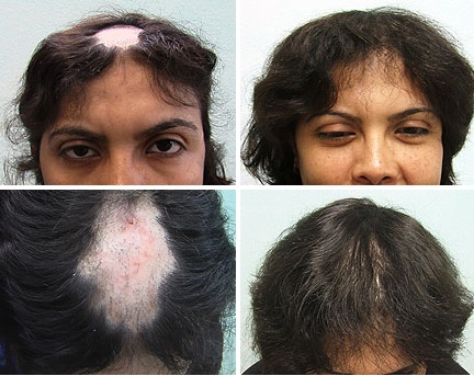 Lupus and Hair Restoration - Before and after UGraft FUE hair Restoration