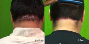 Back of Head Razor Bumps - AKN - DermHair Clinic 310-318-1500