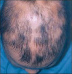 Child Hair Loss - Widespread alopecia areata