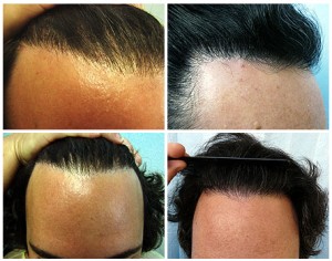 Body Hair Transplant: Hairline Repair Using Leg Hair before and after photos