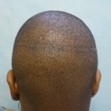 patient's strip scar which required transplant repair with FUE