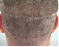 The Truth About Strip Surgery Hair Transplantation Procedure - strip scar