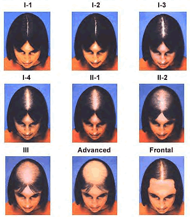 ludwig scale for female hair loss patterns 
