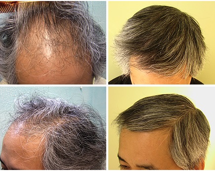 Before and After Asian FUE Hair Transplant - 3000 Grafts