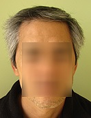 Asian FUE Hair Transplant Patient