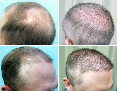 Baldness cure with Body Hair Transplant: View of Crown and Temples| BHT Surgery Results- Norwood 6 Patient