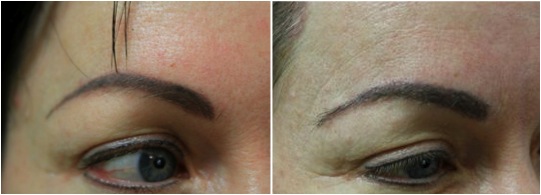 closeup eyebrow transplant results nape hair closeup eyebrow transplant results nape hair