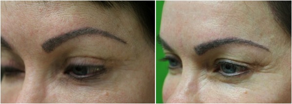 excellent eyebrow transplant results on patient excellent eyebrow transplant results on patient