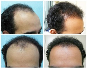 FUE Hair Transplant Using 3500 grafts for NW 4 , before and after