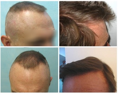 Follicular Unit Extraction For Hair Transplants with Less scarring