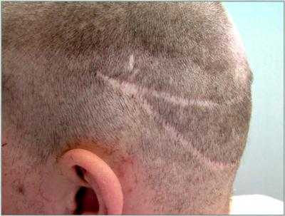 Camoflaging The Scar Of Strip Surgery Camoflaging The Scar Of Strip Surgery