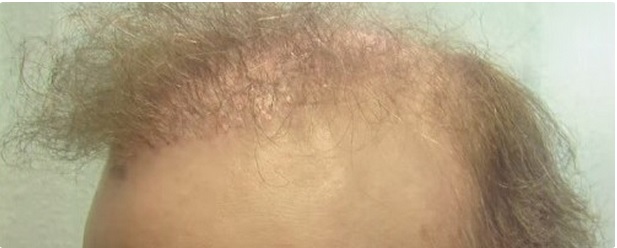 Botched Hair Restoration|Patient Repair Case