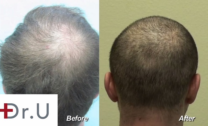 Beard Hair Fills In Patient's Crown