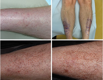 restoration of leg hair