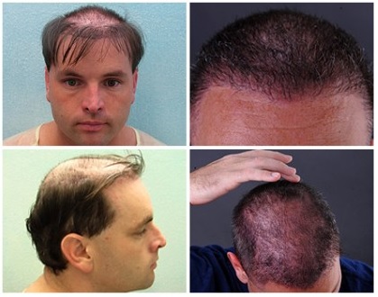 UGraft Hair Transplant repair Using 19500 Grafts Ends Hairpiece Usage