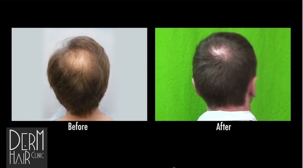 Before and After Advanced FUE|Crown Hair Restoration