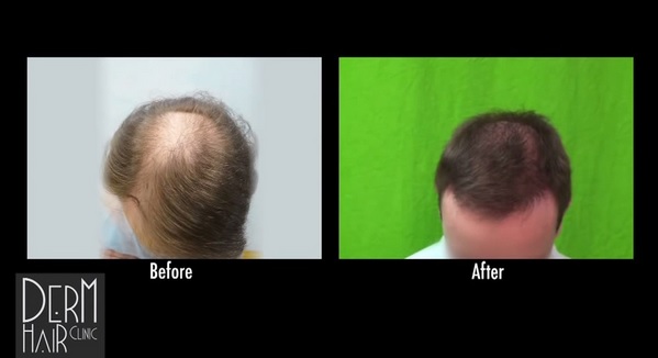 FUE hair transplant 3500 grafts - Front View of Hair Loss|Before & After