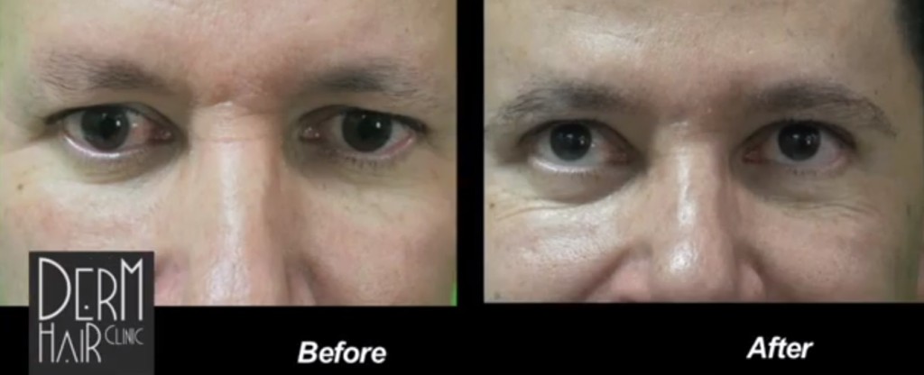 Leg Hair Eyebrow Transplant Results Leg Hair Eyebrow Transplant Results