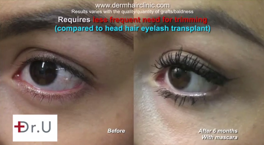 Example of a before and after result of UGraft eyelash hair transplant using leg hair