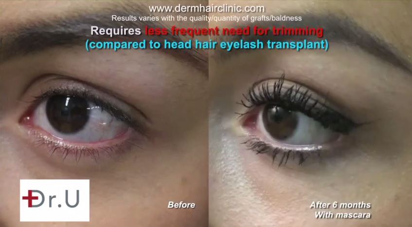 Eyelash Transplant Results| Leg Hair Grafts - Left Eye