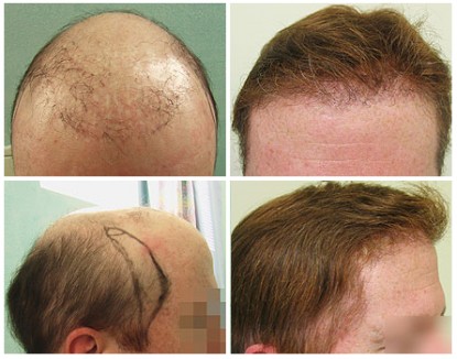 Hair Restoration testimonials by Shawn before and after photos of Dr U Repair 