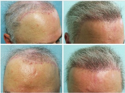 Before and After Hair Restoration Repair for Past Hair Surgeries Using UGraft - Hairline scars and deformities hair flap surgeries Before and After Hair Restoration Repair for Past Hair Surgeries Using UGraft - Hairline scars and deformities hair flap surgeries