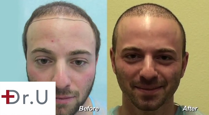 Patient's New Hairline|Before & After BHT Surgery