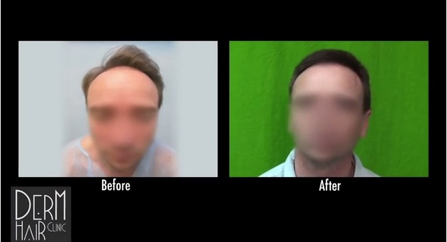New FUE Hairline| Front View of Patient's Face