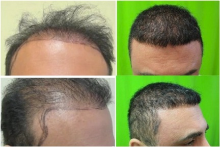 UGraft Temple Region Hair Restoration results in a patient