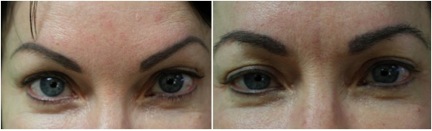 eyebrow hair transplant | nape hair grafts | before & after