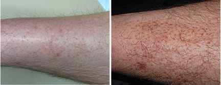 Body hair Restoration; Body Hair to Leg Transplantation : Historic First Body hair Restoration; Body Hair to Leg Transplantation : Historic First