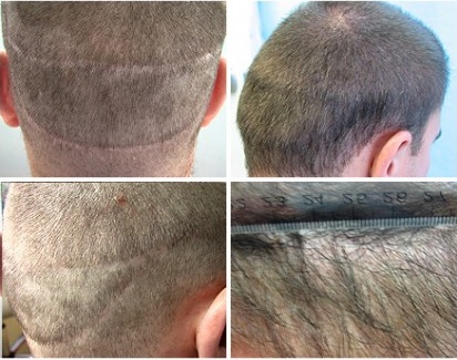 Hair Transplant Strip Surgery Scar Repair Using UGraft FUE before and after photos