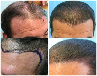 Hair Transplant Repair Using UGraft in Los Angeles : Repair of Temporoparietal-Occipital Flaps (aka, Juri flap or Flemming Mayer flaps)