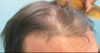 results of a hair transplant procedure. FUE hair transplant grafts were inserted to correct the unnatural looking errors which resulted from a Juri flap surgery.